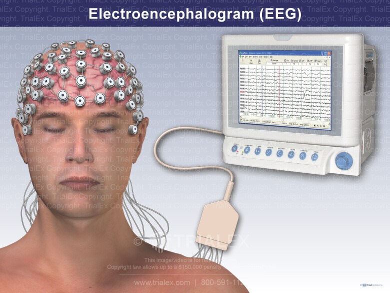 Electroencephalogram(EEG)